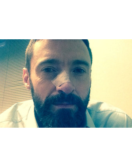 HUGH JACKMAN ha vuelto a ser operado por CANCER DE PIEL EN LA NARIZ